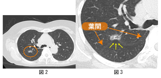 chest CT1.jpg